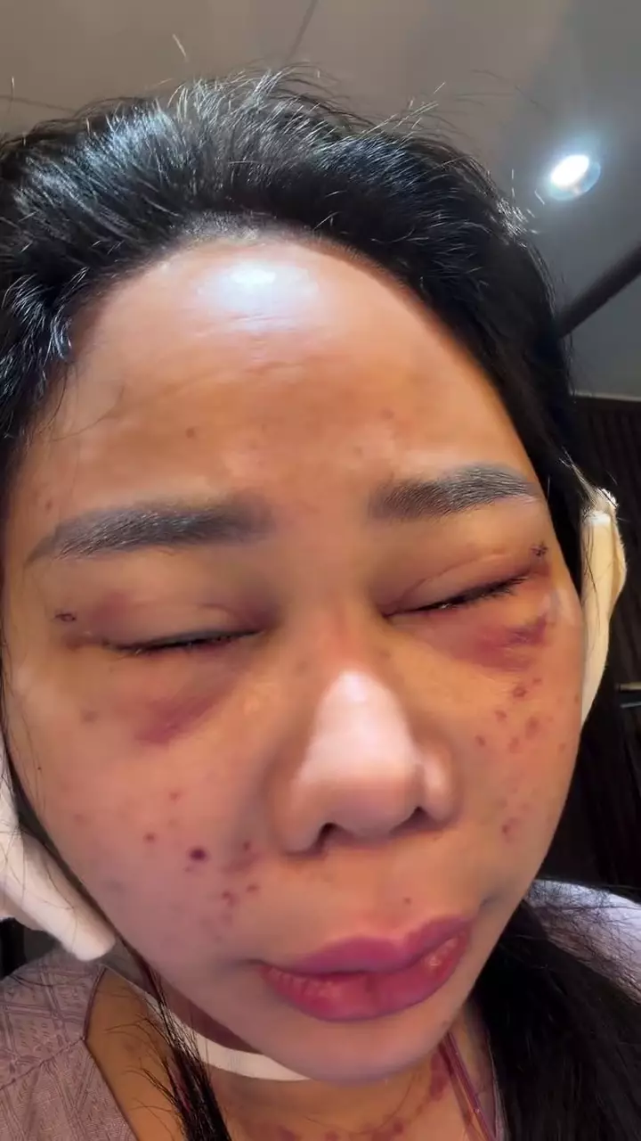 Denise Chariesta oplas wajah di Korea Selatan © 2025 Instagram Denise Chariesta oplas wajah di Korea Selatan © 2025 Instagram