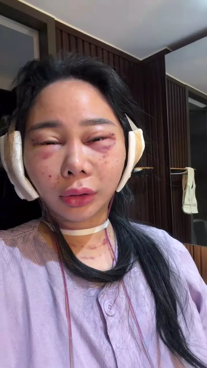 Denise Chariesta oplas wajah di Korea Selatan © 2025 Instagram Denise Chariesta oplas wajah di Korea Selatan © 2025 Instagram