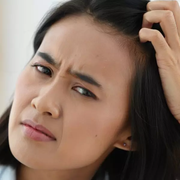 5 Cara mengatasi ketombe basah dengan bahan alami, ampuh dan aman dipakai rutin