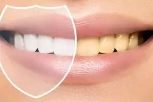 Trik hilangkan noda kuning membandel pada gigi pakai 1 jenis bahan minuman, bukan cuma kunyit