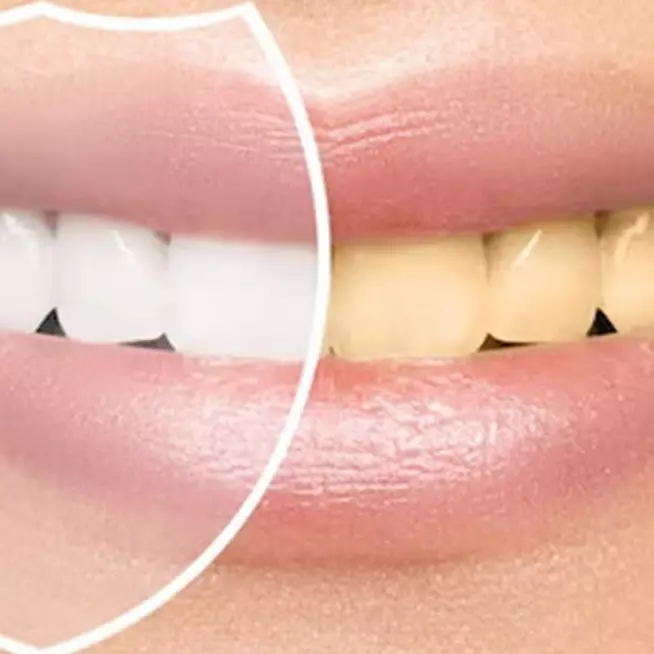 Trik hilangkan noda kuning membandel pada gigi pakai 1 jenis bahan minuman, bukan cuma kunyit