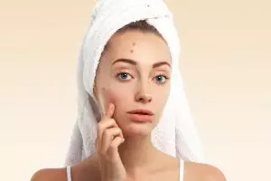 Tanpa serum acne, cara pudarkan bekas jerawat membandel pakai pemanis alami yang mudah dicoba