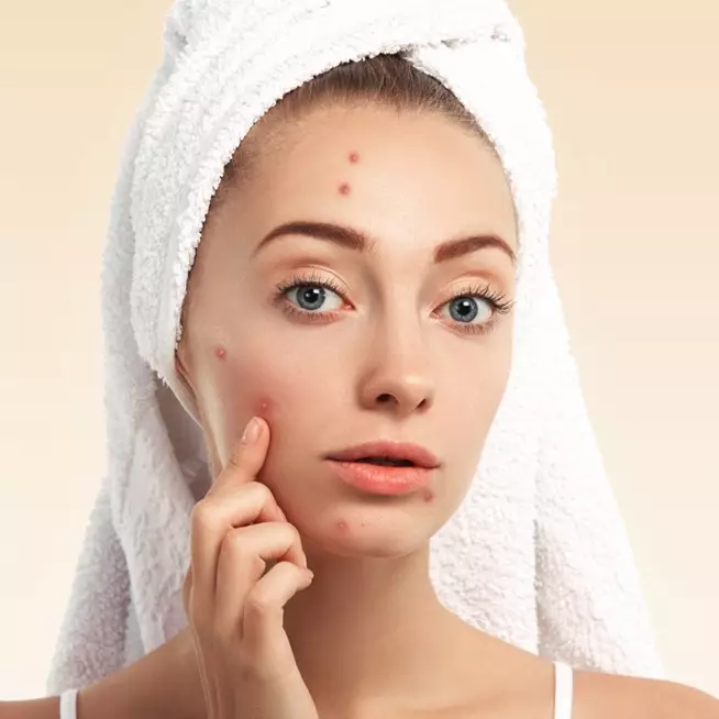 Tanpa serum acne, cara pudarkan bekas jerawat membandel pakai pemanis alami yang mudah dicoba