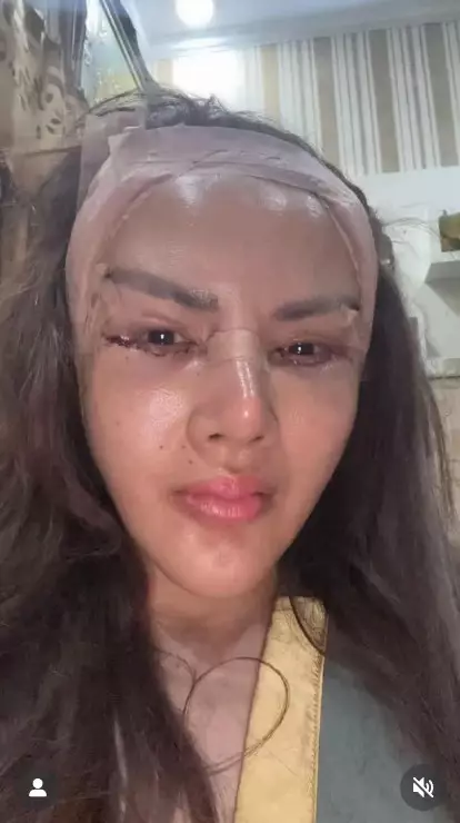 Barbie Kumalasari operasi plastik 8 kali © Instagram