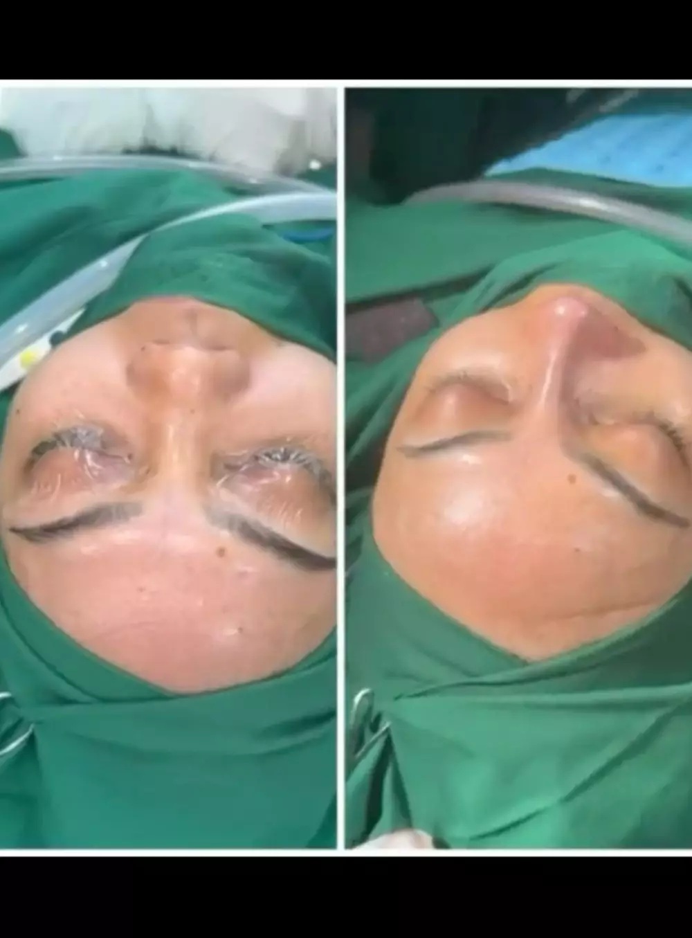 Rina Nose Operasi Hidung Instagram/@rinanose16