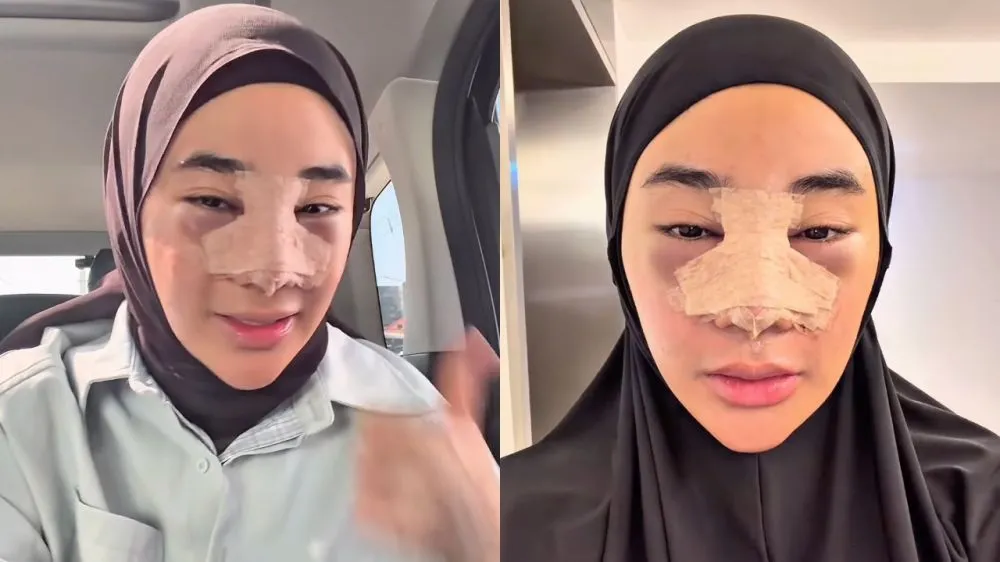 Clara Shinta Operasi Hidung © 2026 