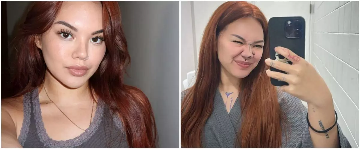 Sudah jadi impiannya sejak SMP, ini 7 potret Shafa Harris jalani oplas hidung di Korea Selatan