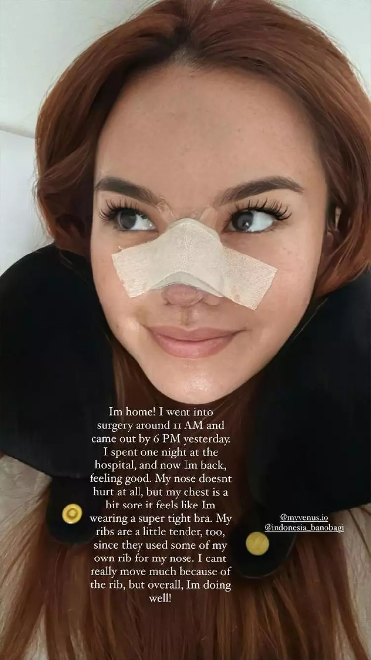 Sudah jadi impiannya sejak SMP, ini 7 potret Shafa Harris jalani oplas hidung di Korea Selatan