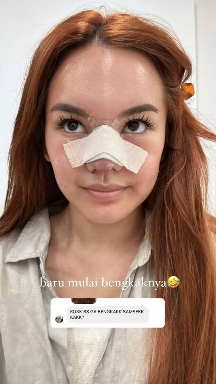 Sudah jadi impiannya sejak SMP, ini 7 potret Shafa Harris jalani oplas hidung di Korea Selatan