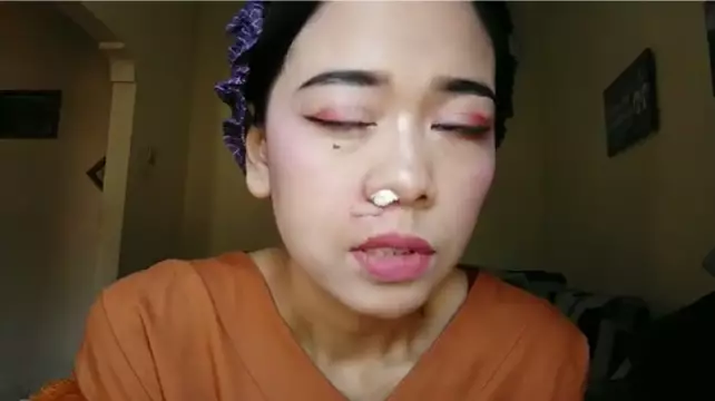 cara mudah atasi keloid Berbagai sumber
