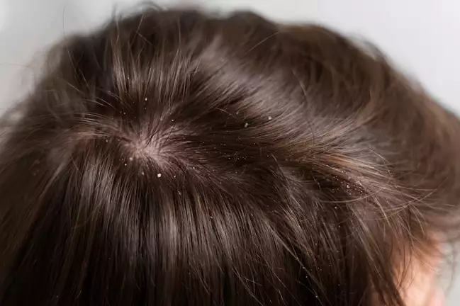 cara atasi ketombe basah hanya menggunakan bahan alami Berbagai sumber cara atasi ketombe basah hanya menggunakan bahan alami Berbagai sumber