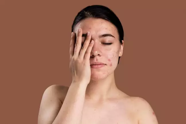 cara memilih kandungan acne spot treatment sesuai jenis jerawat berbagai sumber