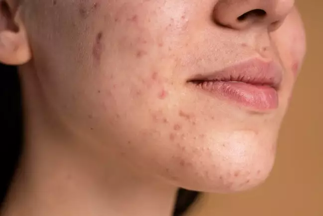 cara memilih kandungan acne spot treatment sesuai jenis jerawat berbagai sumber