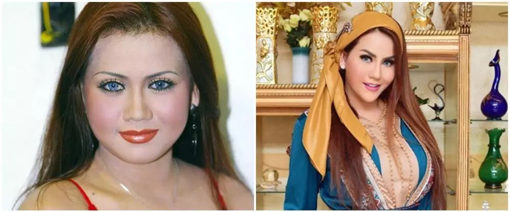 penampilan penyanyi sebelum dan sesudah operasi © berbagai sumber