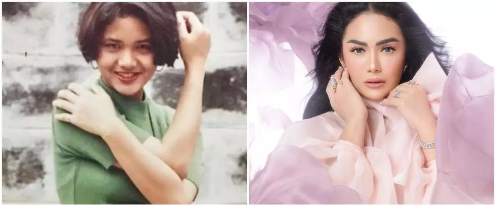 penampilan penyanyi sebelum dan sesudah operasi © berbagai sumber