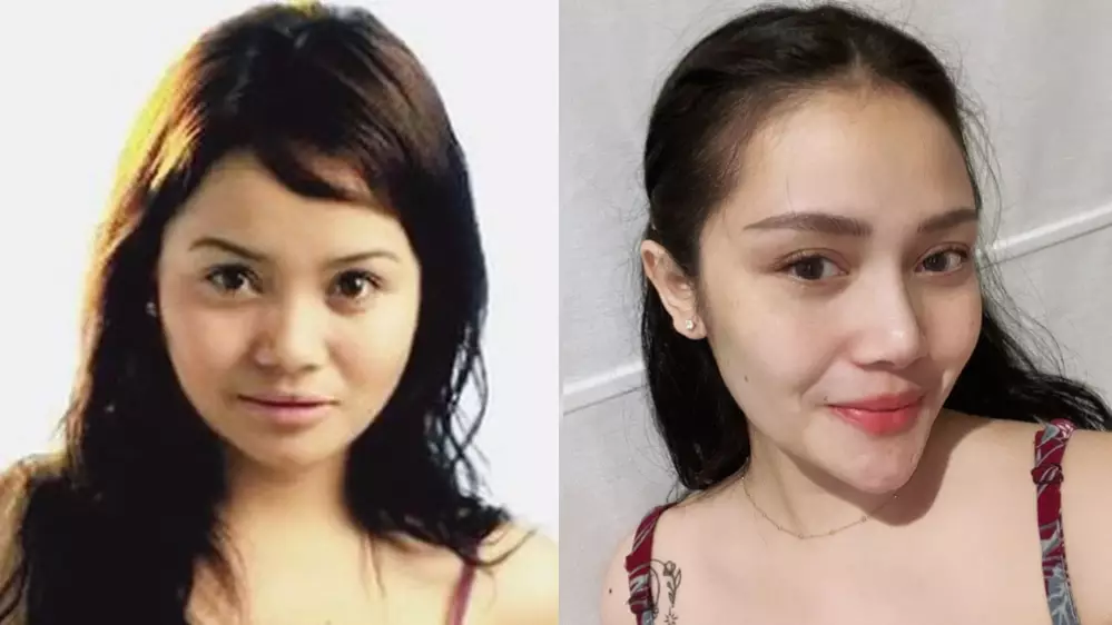 penampilan penyanyi sebelum dan sesudah operasi © berbagai sumber