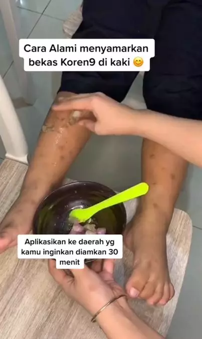 Cara menyamarkan bekas koreng pada kaki pakai 2 bahan dapur Berbagai sumber Cara menyamarkan bekas koreng pada kaki pakai 2 bahan dapur Berbagai sumber