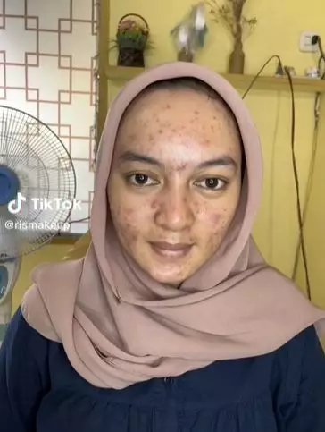  wajah wanita penuh jerawat  © 2023 brilio.net