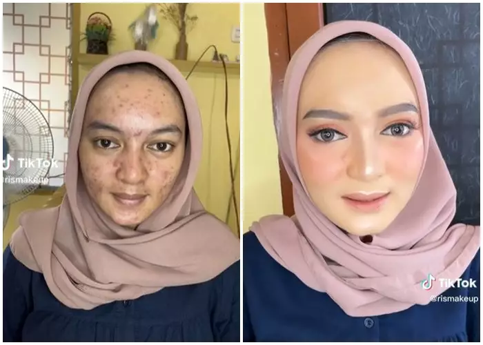  wajah wanita penuh jerawat  © 2023 brilio.net