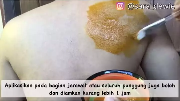  Cara  mengatasi jerawat punggung dan bekasnya berbagai sumber