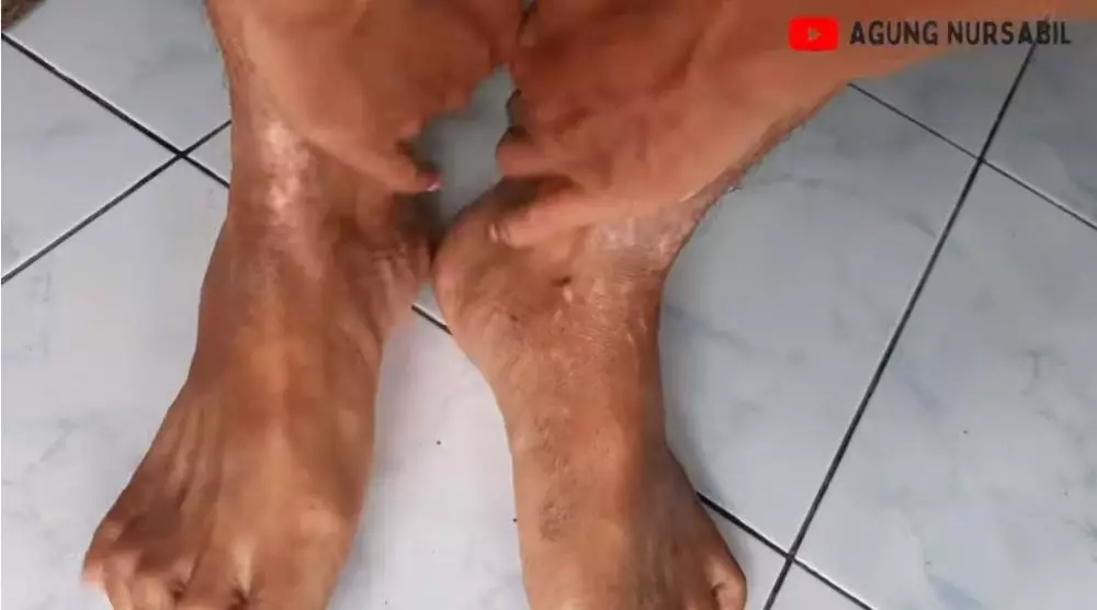 cara atasi eksim di tangan berbagai sumber