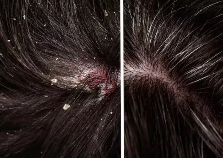 Kelebihan minyak kelapa untuk rambut © freepik.com Kelebihan minyak kelapa untuk rambut © freepik.com