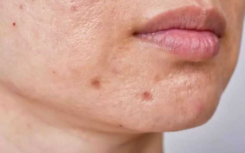 Manfaat cengkeh untuk kecantikan wajah © 2023 berbagai sumber Manfaat cengkeh untuk kecantikan wajah © 2023 berbagai sumber