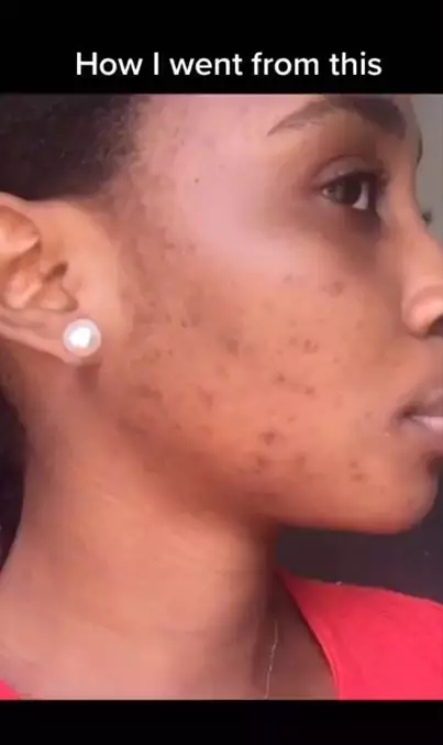 Cara memudarkan flek hitam bekas jerawat pakai 4 bahan alami Berbagai sumber