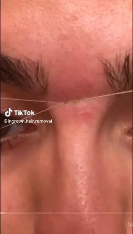 trik hilangkan bulu halus di sekitar alis berbagai sumber trik hilangkan bulu halus di sekitar alis berbagai sumber