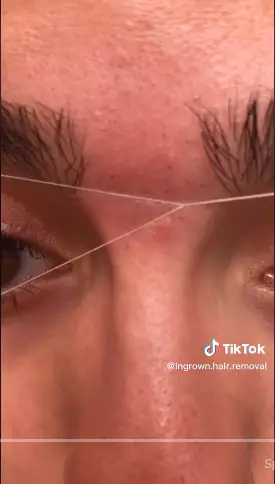 trik hilangkan bulu halus di sekitar alis berbagai sumber trik hilangkan bulu halus di sekitar alis berbagai sumber