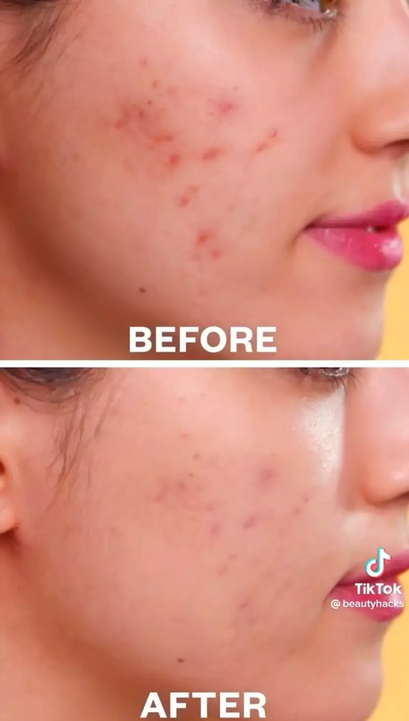 Masker wajah 1 bahan dapur samarkan bekas jerawat © 2023 berbagai sumber Masker wajah 1 bahan dapur samarkan bekas jerawat © 2023 berbagai sumber