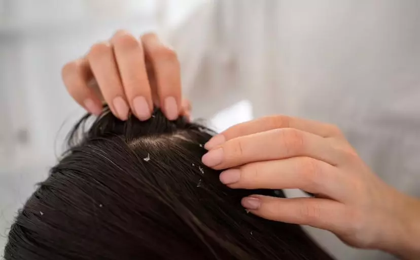 kelebihan habbatussauda untuk kesehatan rambut © 2023 brilio.net