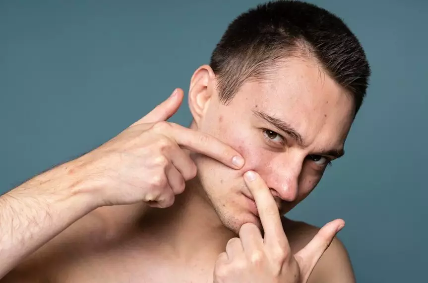 cara mengatasi ingrown hair Istimewa