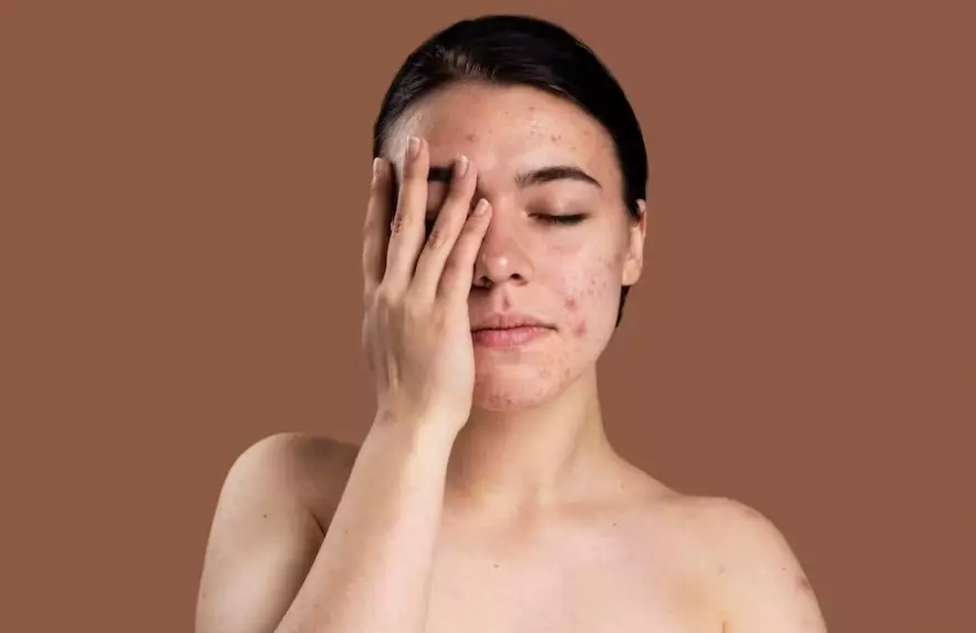 fungsi salicylic acid untuk kesehatan kulit © 2023 brilio.net fungsi salicylic acid untuk kesehatan kulit © 2023 brilio.net