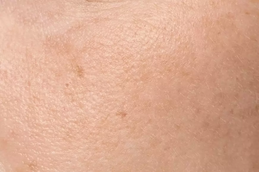 fungsi salicylic acid untuk kesehatan kulit © 2023 brilio.net fungsi salicylic acid untuk kesehatan kulit © 2023 brilio.net