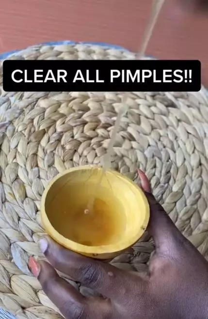 Trik mengempiskan jerawat membandel cuma pakai 2 bahan alami Berbagai sumber Trik mengempiskan jerawat membandel cuma pakai 2 bahan alami Berbagai sumber