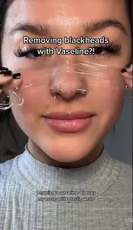 trik atasi komedo pada hidung berbagai sumber