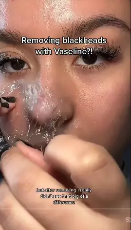 trik atasi komedo pada hidung berbagai sumber