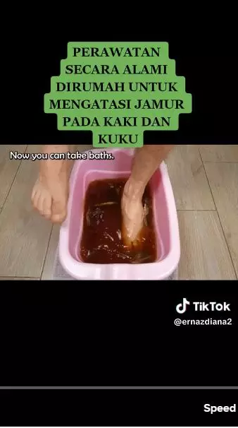  trik atasi jamur kuku dan kaki berbagai sumber