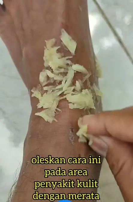 Cara menghilangkan gatal akibat panu pakai 1 bumbu dapur Berbagai sumber