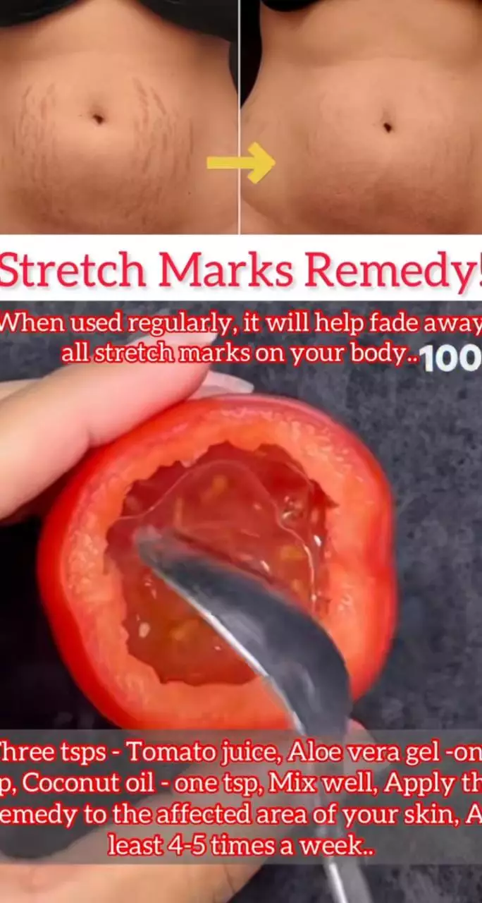 samarkan stretchmark pakai masker dari 3 bahan dapur © 2023 brilio.net samarkan stretchmark pakai masker dari 3 bahan dapur © 2023 brilio.net