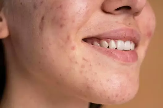 kelebihan daun kunyit untuk kecantikan © 2023 brilio.net kelebihan daun kunyit untuk kecantikan © 2023 brilio.net