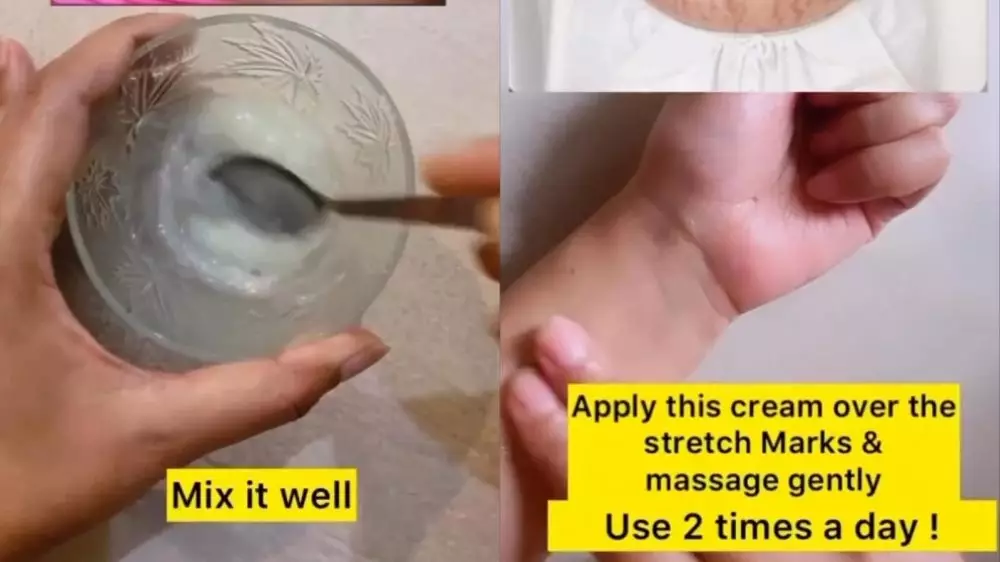 hilangkan stretch marks di badan © Instagram hilangkan stretch marks di badan © Instagram