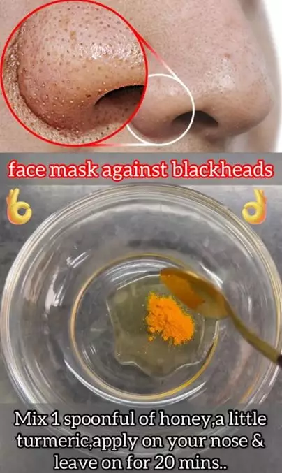 Trik hilangkan komedo hitam di hidung pakai 1 jenis rempah Berbagai sumber Trik hilangkan komedo hitam di hidung pakai 1 jenis rempah Berbagai sumber