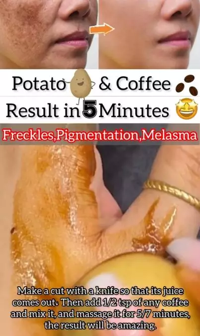 Trik atasi noda hiperpigmentasi wajah pakai 1 jenis umbi-umbian Berbagai sumber