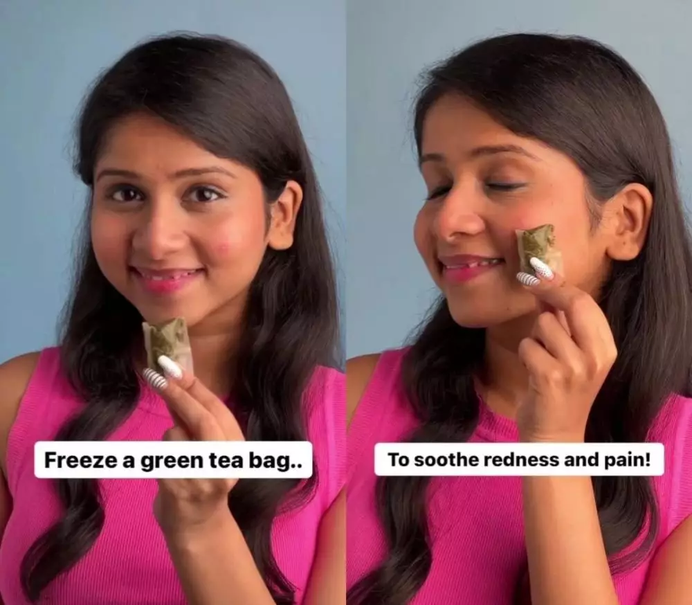 jerawat meradang kempes © Instagram jerawat meradang kempes © Instagram