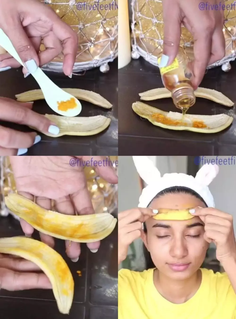 pigmentasi dahi dan garis senyum © Instagram pigmentasi dahi dan garis senyum © Instagram