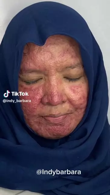 makeup jerawat parah © TikTok makeup jerawat parah © TikTok