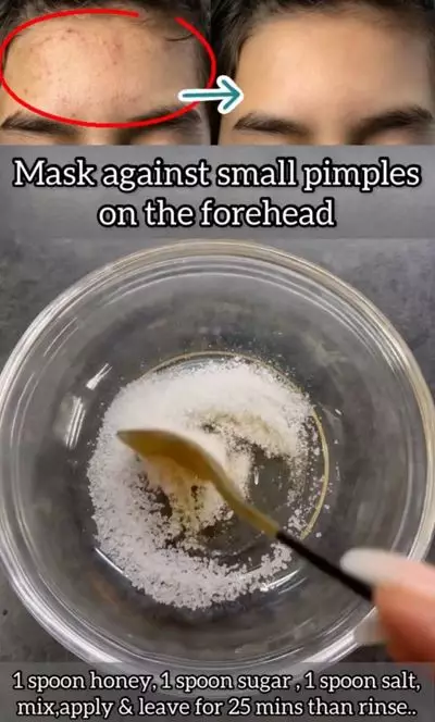 Hilangkan beruntusan pada dahi pakai 2 bahan pemanis Berbagai sumber