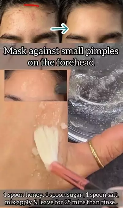 Hilangkan beruntusan pada dahi pakai 2 bahan pemanis Berbagai sumber